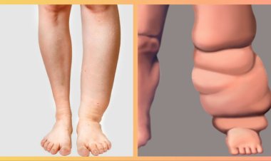 छत्तीसगढ़ में फाइलेरिया 'हाथीपांव' के विरुद्ध 'जंग'; स्वास्थ्य कार्यकर्ता घर-घर खिलाएंगे दवा